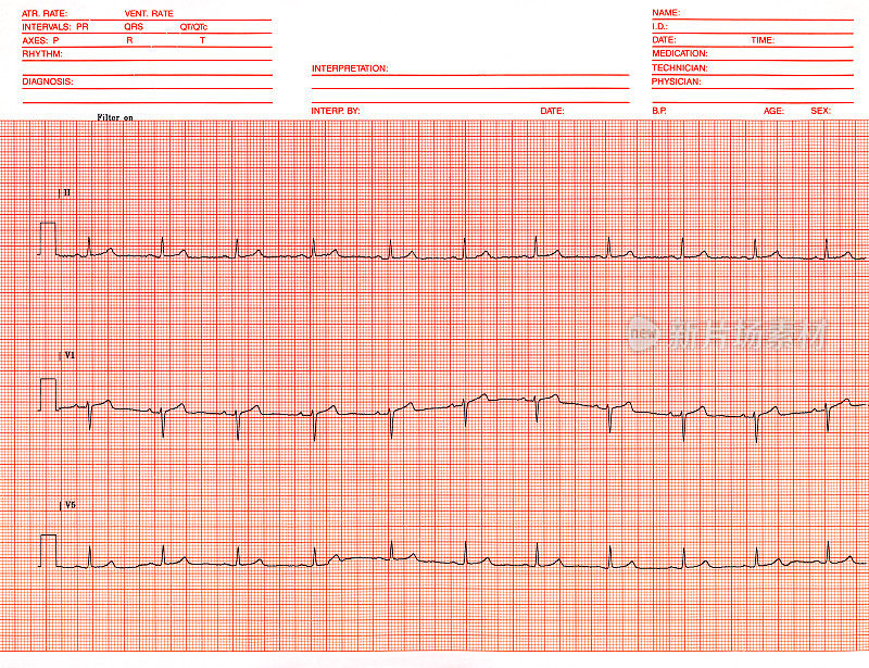 ECG 报告